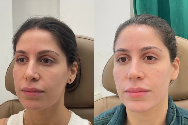 DermalFiller_TemplesCheeksLips-1