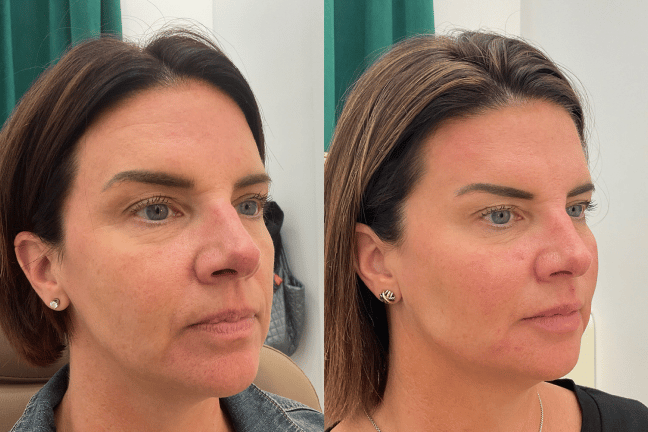 FullFaceRejuvenation