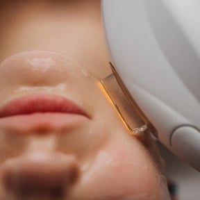 Intense Pulsed Light (IPL)