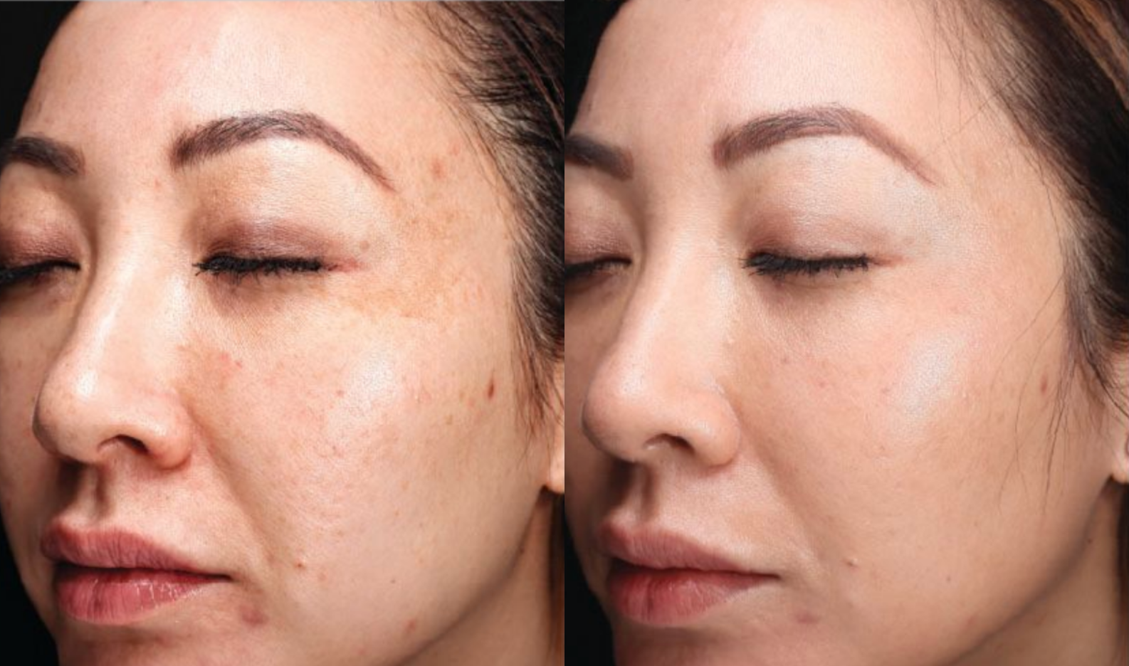 halo®_tribrid™_before_&_after_—_acne_scarring,_pigmentation_&_pore_refinement