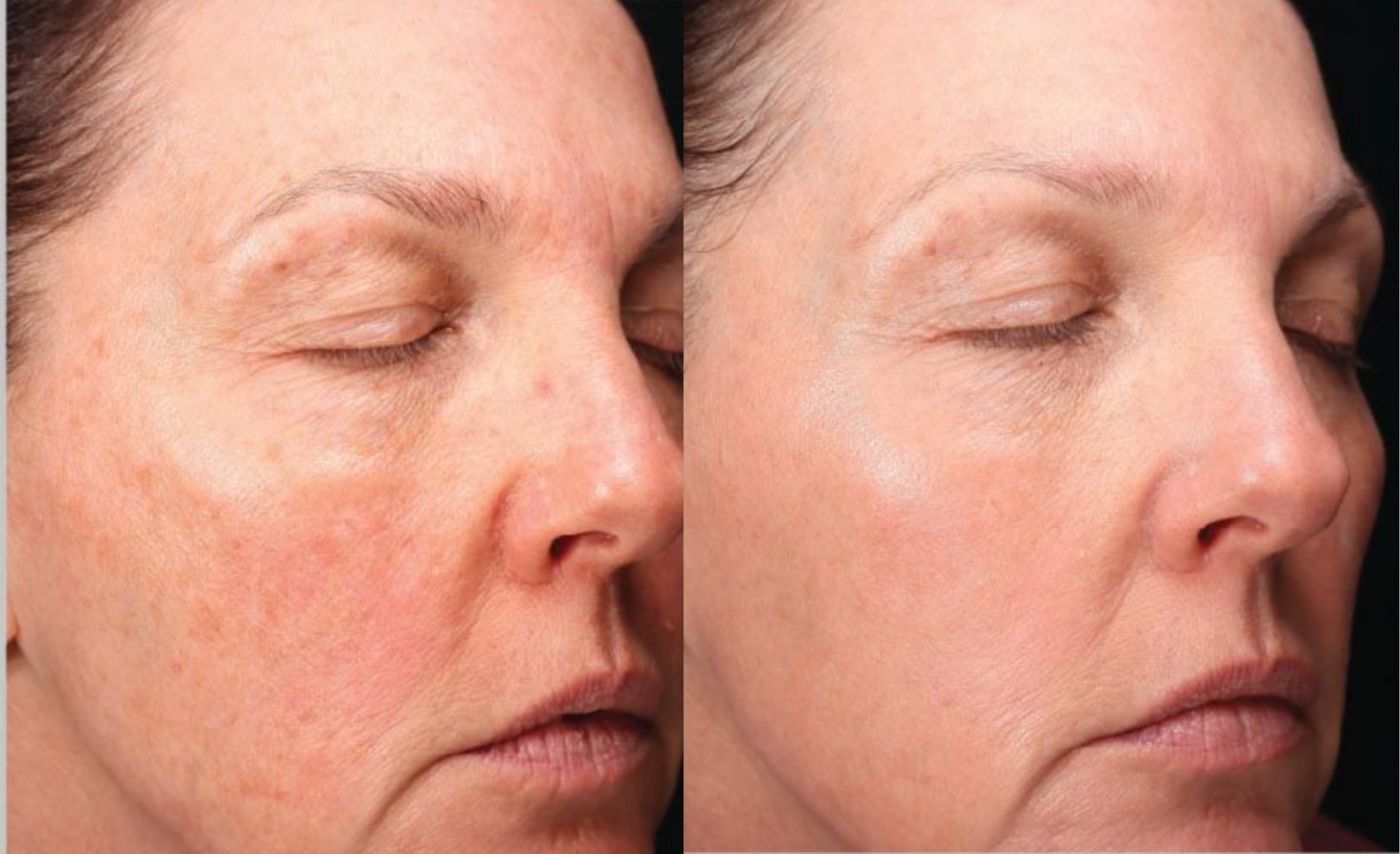 halo®_tribrid™_before_&_after_—_redness_&_sun_damage,_three-quarter_view