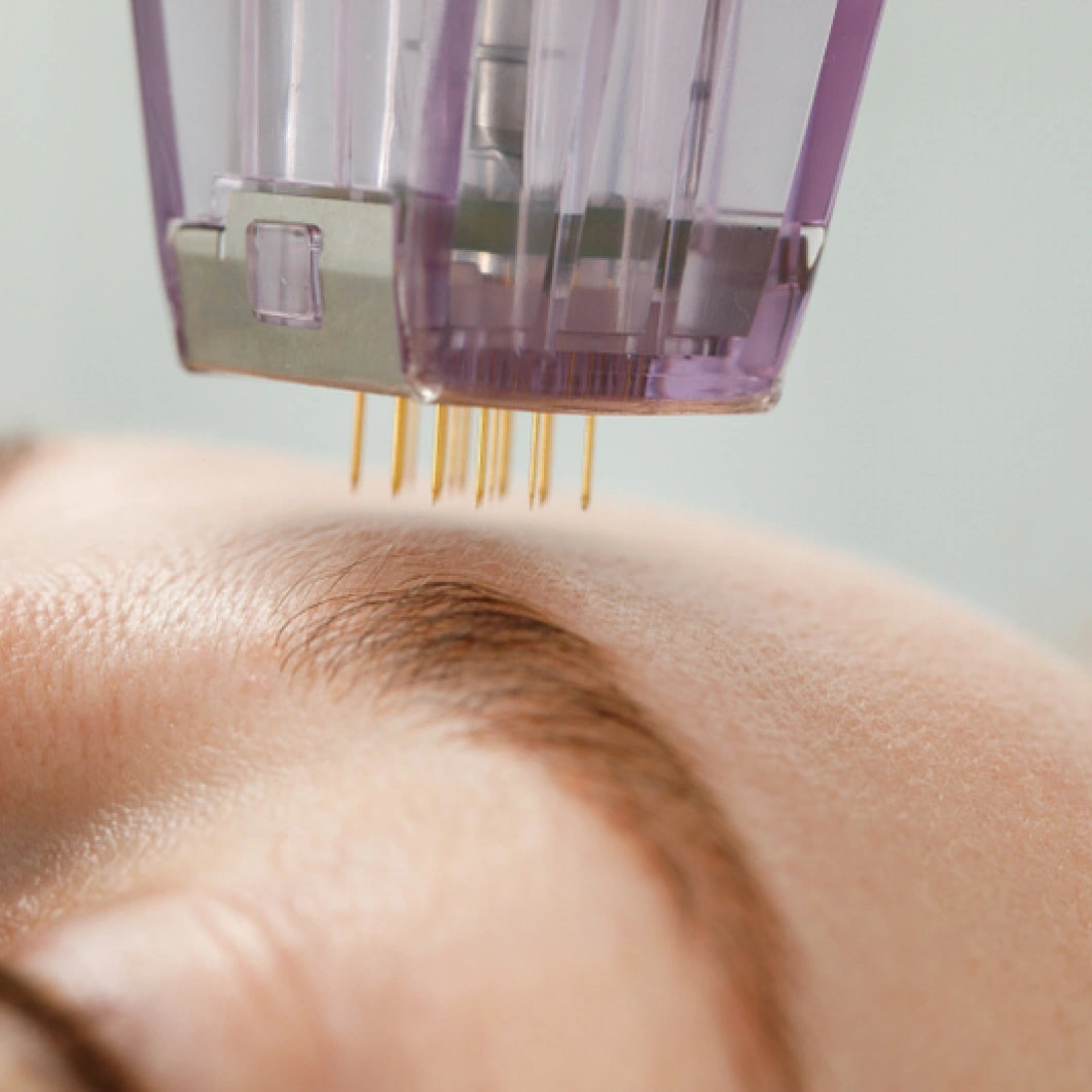 microneedling_with_salmon_dna